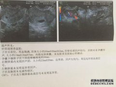 [孕囊和卵黄囊的区别]孕囊和卵黄囊有什么区别？