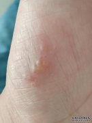 手掌植物脓疱病和汗疱疹有什么区别？