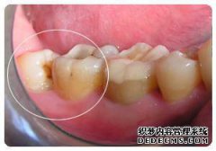拔出智齿后牙腔的白色是什么？