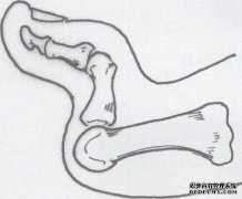 tar趾关节和指间关节的移植