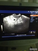 子宫内妊娠早期，妊娠6W左右。你怀孕几天了？