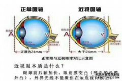 如何选择近视镜片
