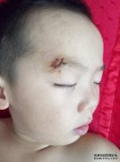 婴儿的前额是否用四针缝制？