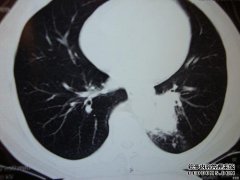 什么是白肺CT片段？