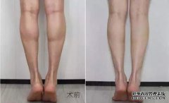 女孩如何收窄腿？