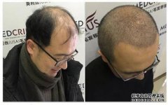 光头上发生了什么？