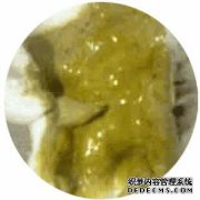 大便有六种形式，只有一种是普通大便